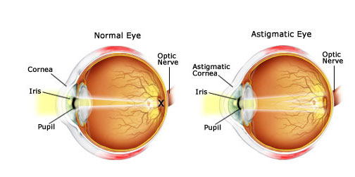 astigmatizam